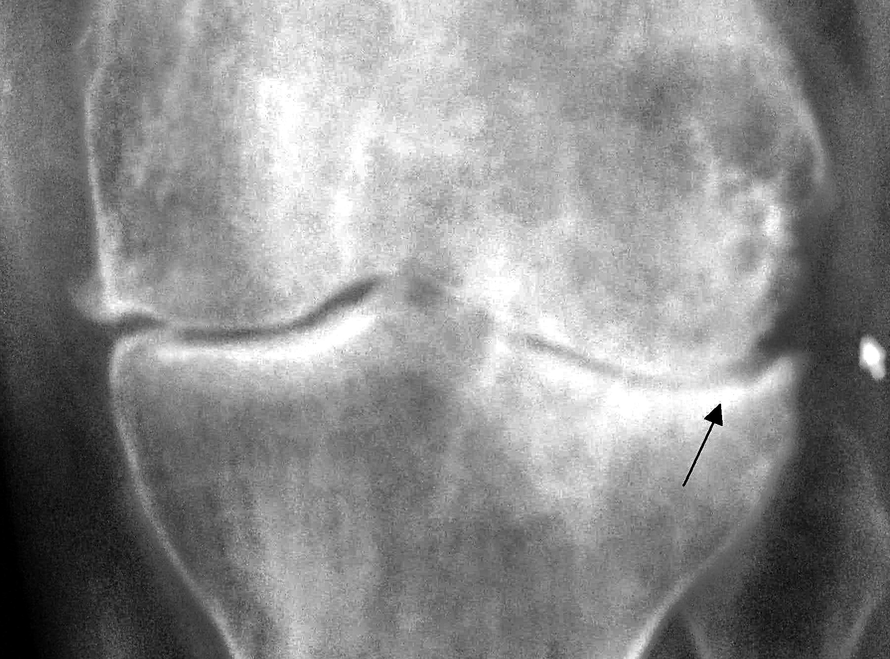 Educational X-ray of a knee with an arrow marking narrowed joint space from osteoarthritis